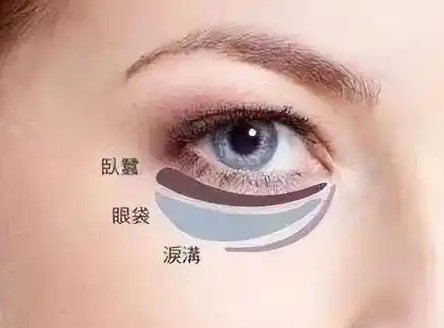 去眼袋手术