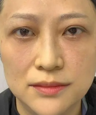 去眼袋手术