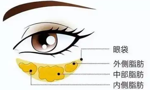 去眼袋手术