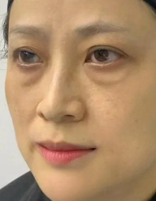 去眼袋手术