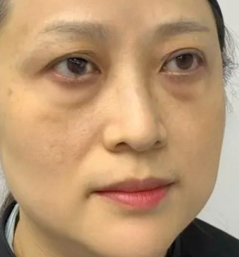 去眼袋手术