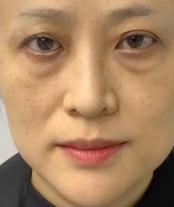 去眼袋手术