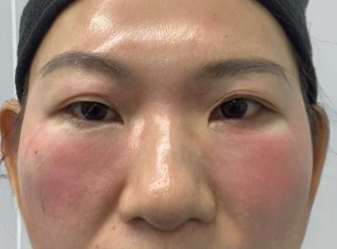 去眼袋手术