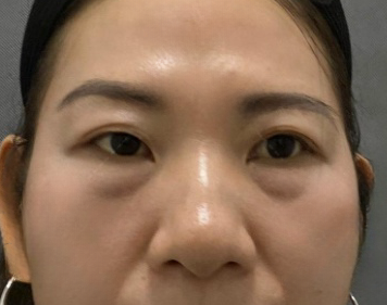 去眼袋手术