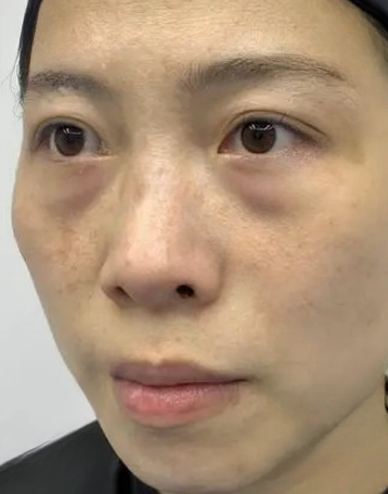 去眼袋手术