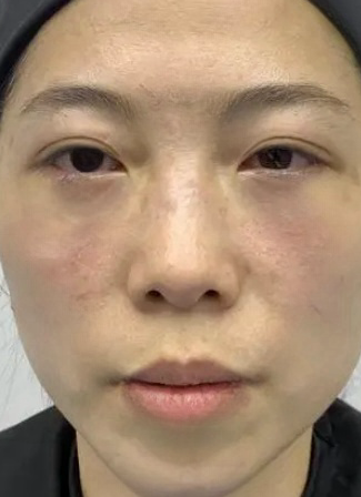 去眼袋手术
