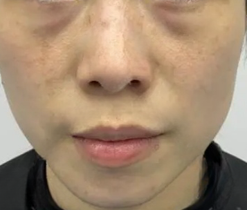 去眼袋手术