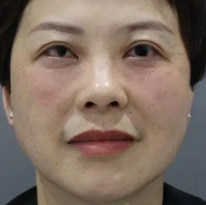 去眼袋手术