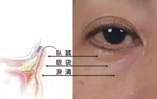 去眼袋手术