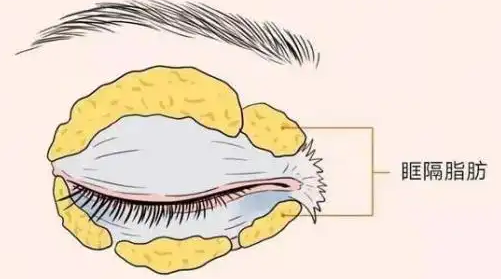 去眼袋手术