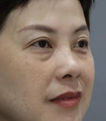 去眼袋手术