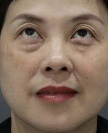 去眼袋手术