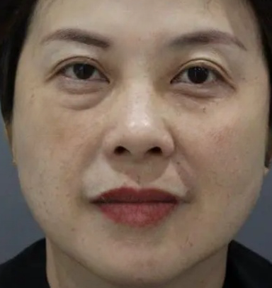 去眼袋手术