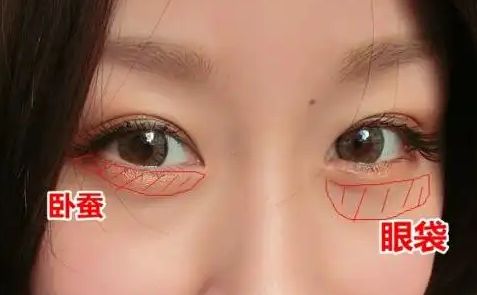 去眼袋手术