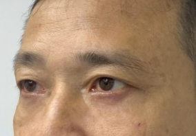 去眼袋手术