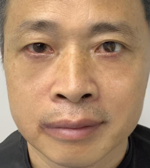 去眼袋手术