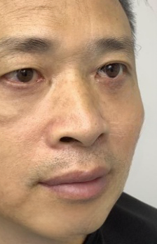 去眼袋手术