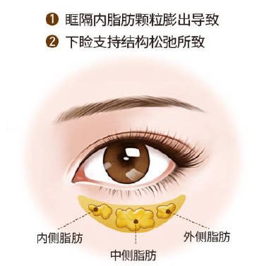 去眼袋手术