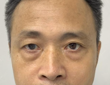 去眼袋手术