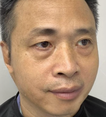 去眼袋手术