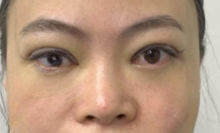 去眼袋手术