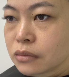 去眼袋手术