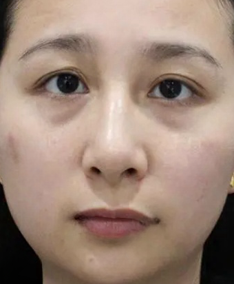 去眼袋手术