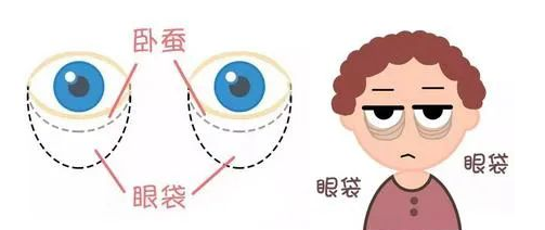 去眼袋手术