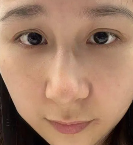 去眼袋手术
