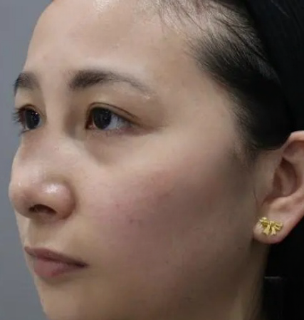 去眼袋手术