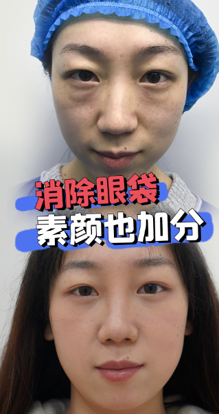 去眼袋手术