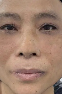 去眼袋手术