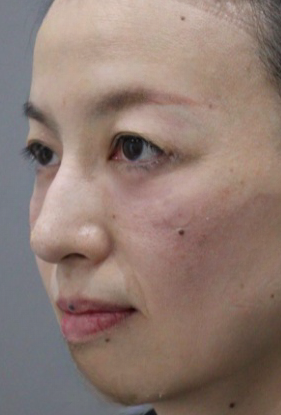去眼袋手术