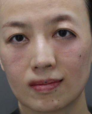 去眼袋手术