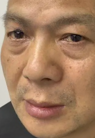 去眼袋手术