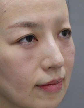 去眼袋手术