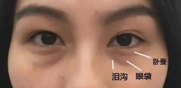 去眼袋手术
