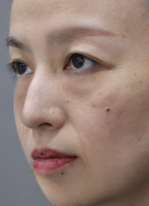去眼袋手术
