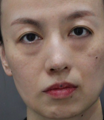 去眼袋手术