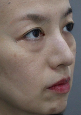 去眼袋手术