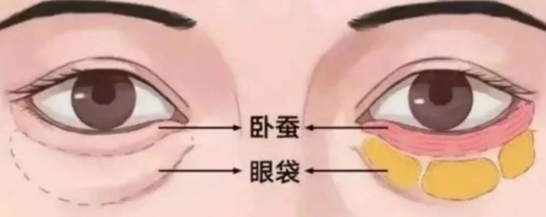 去眼袋手术