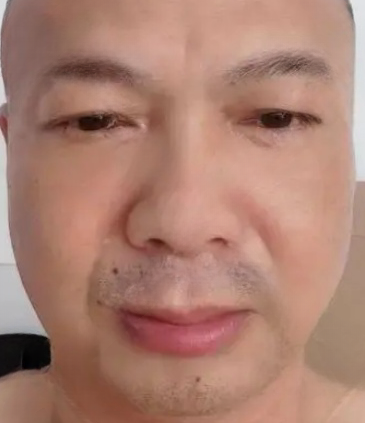 去眼袋手术