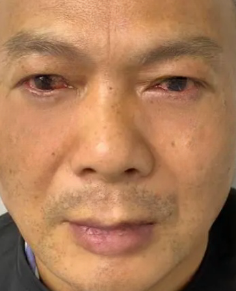 去眼袋手术
