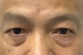 去眼袋手术