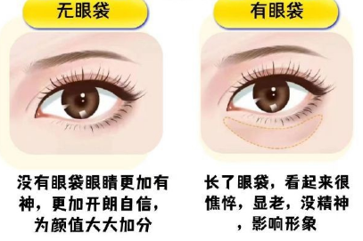 去眼袋手术