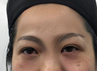去眼袋手术