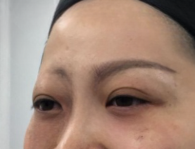 去眼袋手术