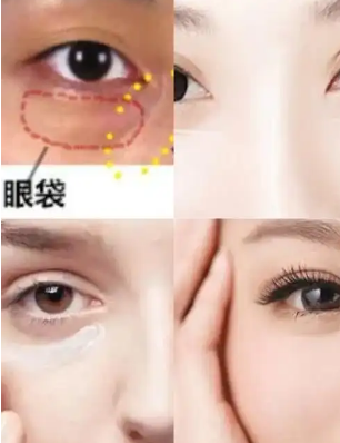 去眼袋手术
