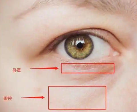 去眼袋手术