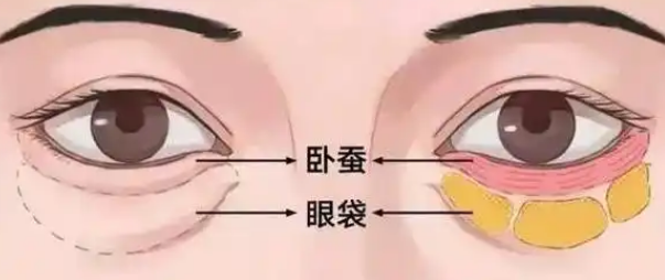 去眼袋手术
